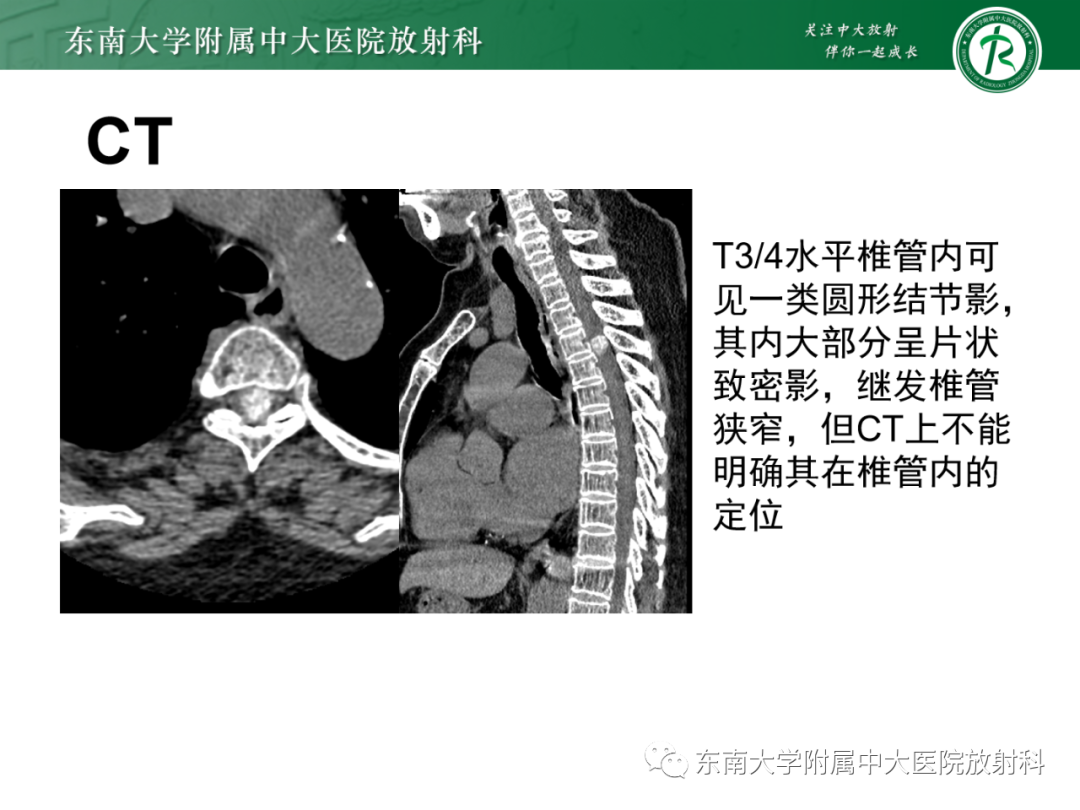 影像PPT - 【PPT】脊柱骨软骨瘤-25
