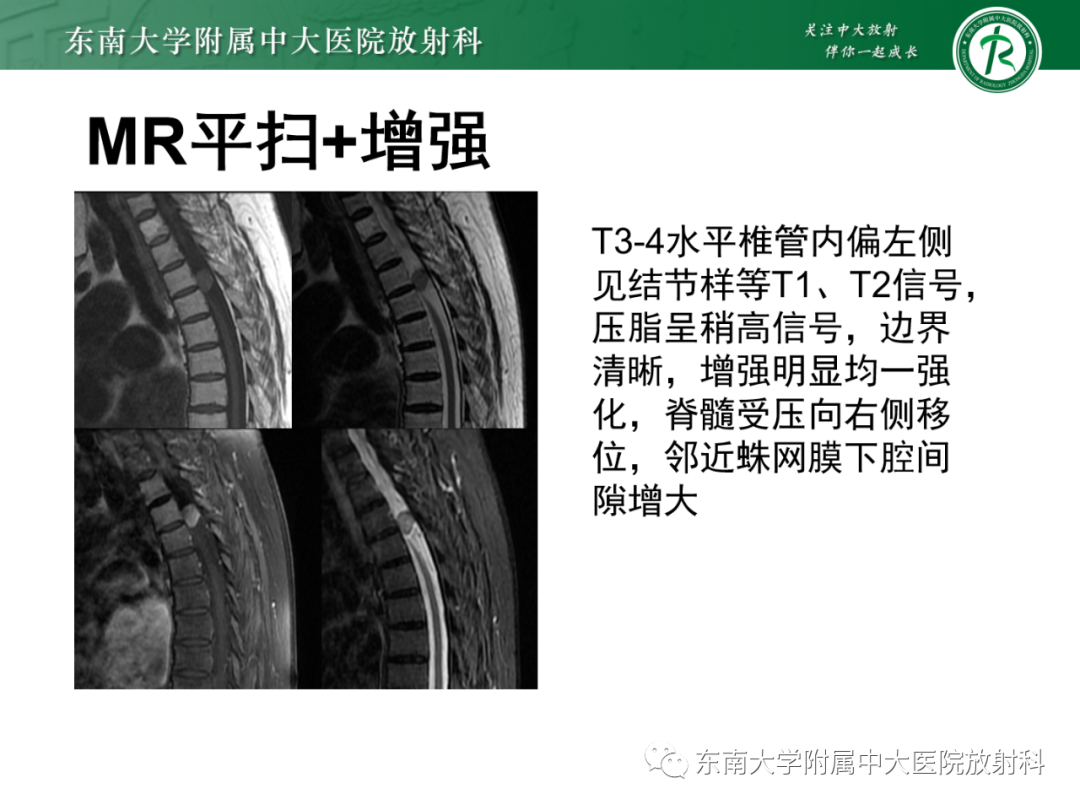 影像PPT - 【PPT】脊柱骨软骨瘤-26