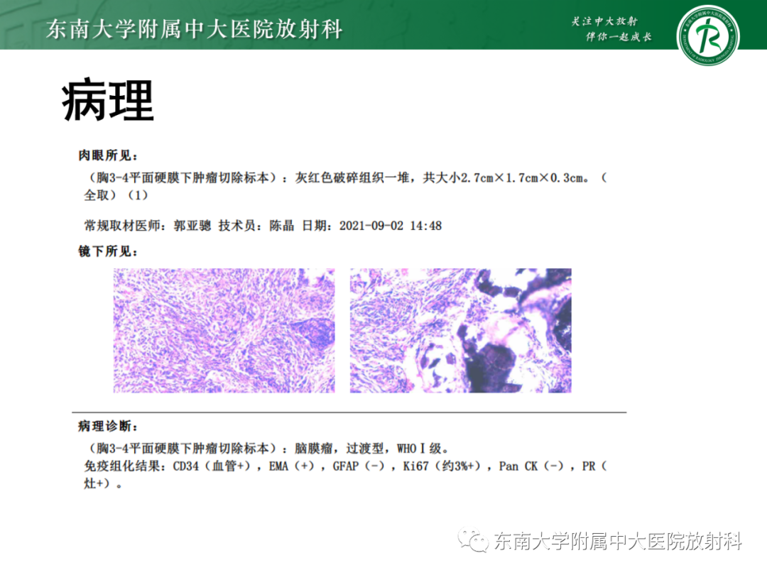 影像PPT - 【PPT】脊柱骨软骨瘤-27