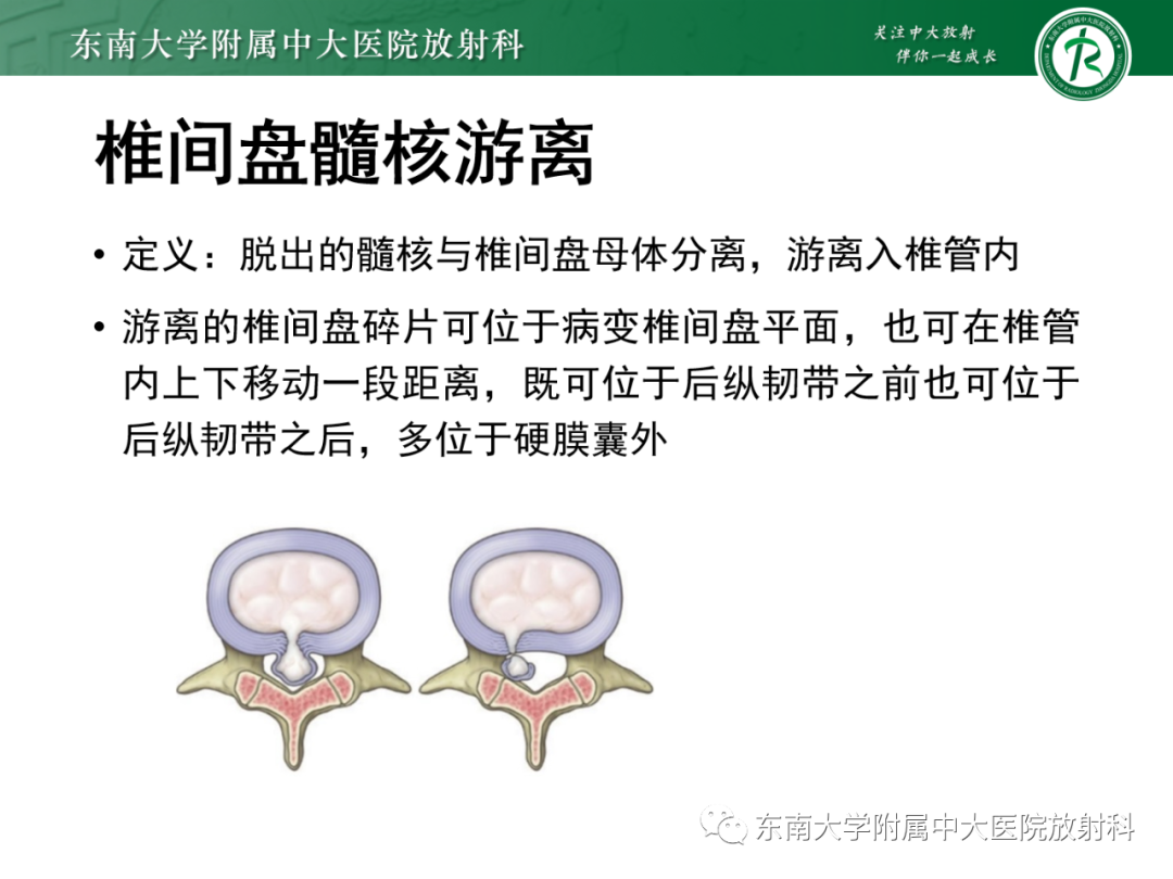 影像PPT - 【PPT】脊柱骨软骨瘤-28