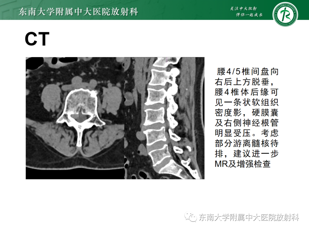 影像PPT - 【PPT】脊柱骨软骨瘤-31