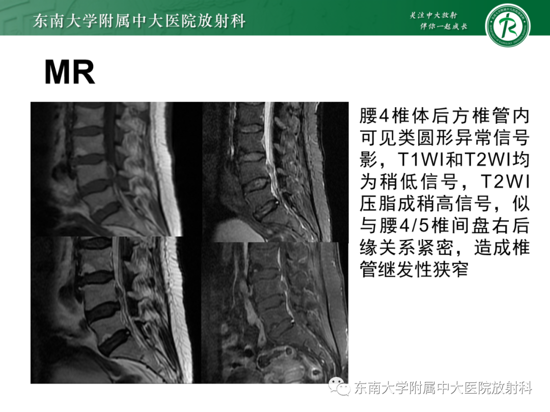 影像PPT - 【PPT】脊柱骨软骨瘤-32