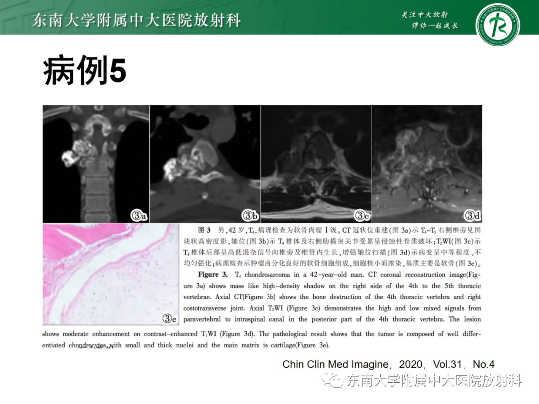 影像PPT - 【PPT】脊柱骨软骨瘤-35