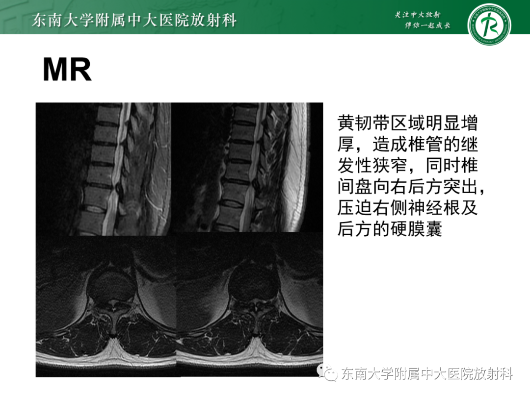 影像PPT - 【PPT】脊柱骨软骨瘤-1