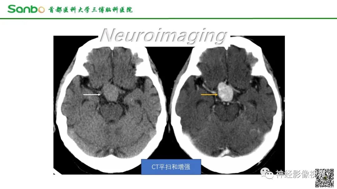 影像PPT - 【病例】鞍区垂体梭形细胞嗜酸细胞瘤1例CT及MR影像-1 影像PPT - 【病例】鞍区垂体梭形细胞嗜酸细胞瘤1例CT及MR影像-1