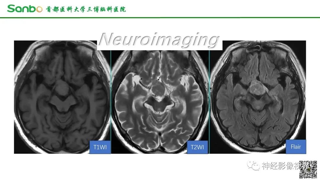 影像PPT - 【病例】鞍区垂体梭形细胞嗜酸细胞瘤1例CT及MR影像-2 影像PPT - 【病例】鞍区垂体梭形细胞嗜酸细胞瘤1例CT及MR影像-2