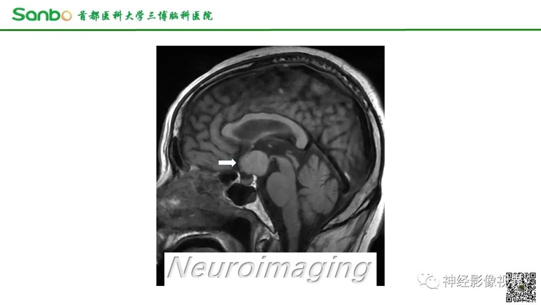影像PPT - 【病例】鞍区垂体梭形细胞嗜酸细胞瘤1例CT及MR影像-3 影像PPT - 【病例】鞍区垂体梭形细胞嗜酸细胞瘤1例CT及MR影像-3