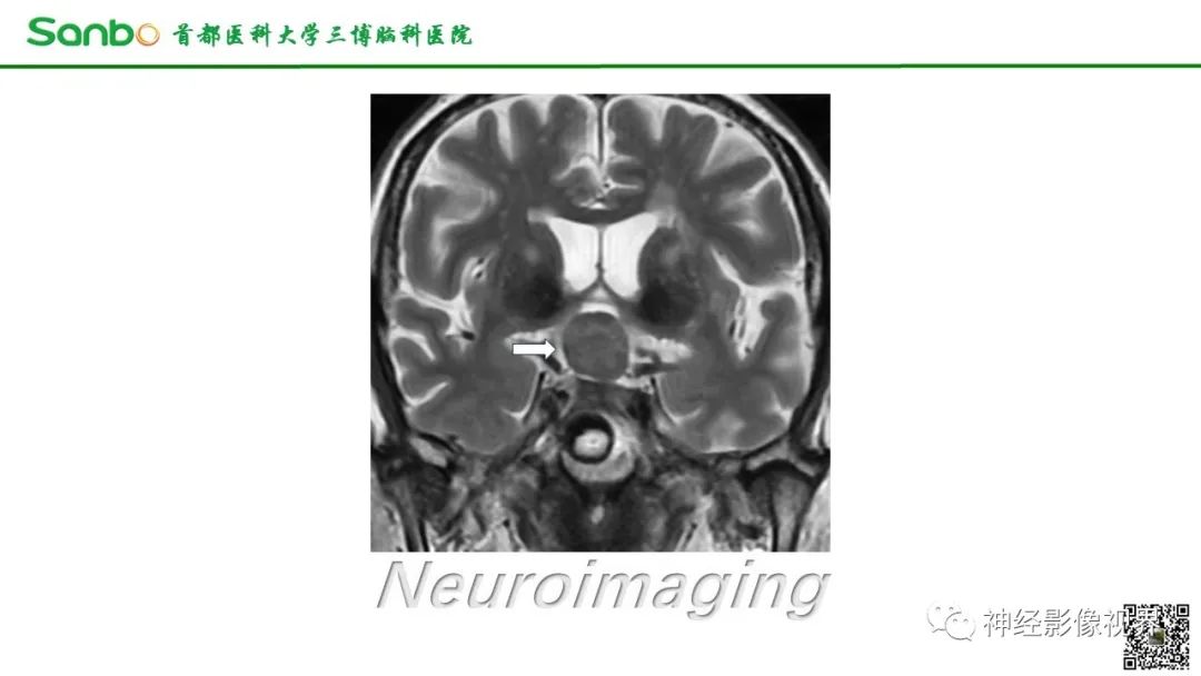 影像PPT - 【病例】鞍区垂体梭形细胞嗜酸细胞瘤1例CT及MR影像-4 影像PPT - 【病例】鞍区垂体梭形细胞嗜酸细胞瘤1例CT及MR影像-4