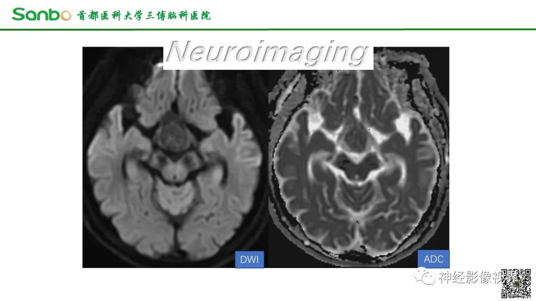 影像PPT - 【病例】鞍区垂体梭形细胞嗜酸细胞瘤1例CT及MR影像-5 影像PPT - 【病例】鞍区垂体梭形细胞嗜酸细胞瘤1例CT及MR影像-5