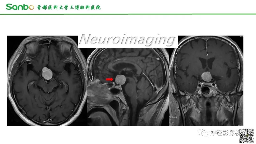 影像PPT - 【病例】鞍区垂体梭形细胞嗜酸细胞瘤1例CT及MR影像-6 影像PPT - 【病例】鞍区垂体梭形细胞嗜酸细胞瘤1例CT及MR影像-6