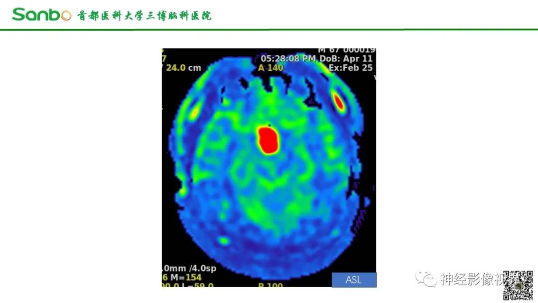 影像PPT - 【病例】鞍区垂体梭形细胞嗜酸细胞瘤1例CT及MR影像-7