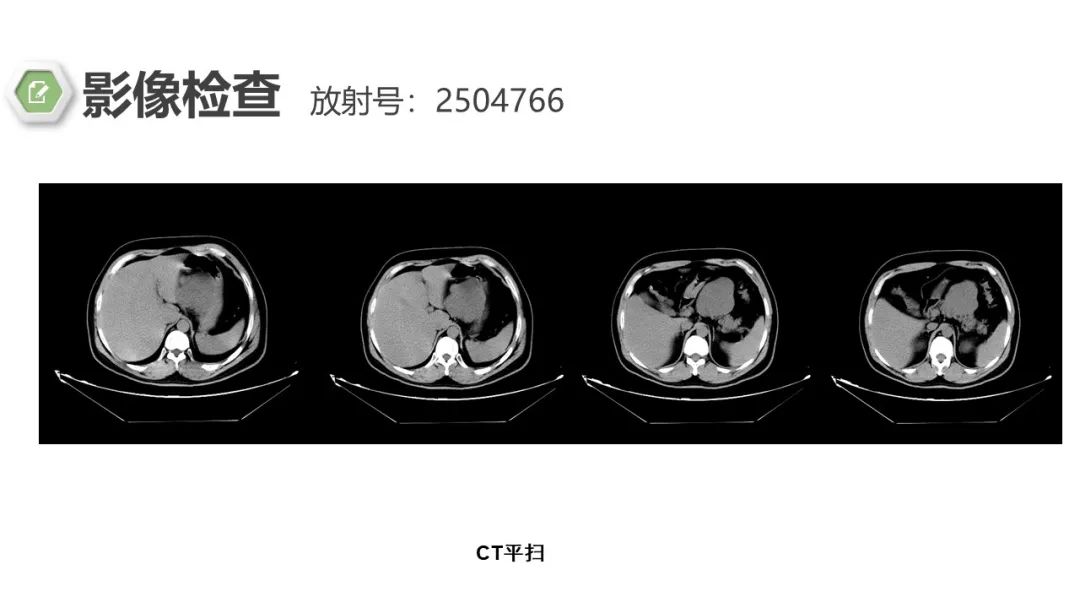 影像PPT - 【病例】胃底间质瘤1例CT影像-4