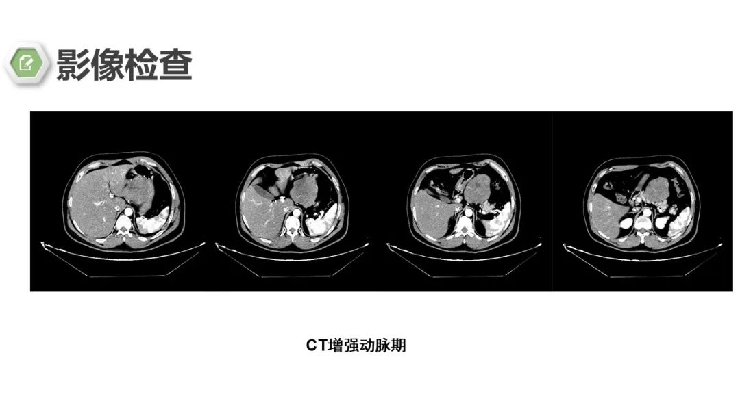 影像PPT - 【病例】胃底间质瘤1例CT影像-5