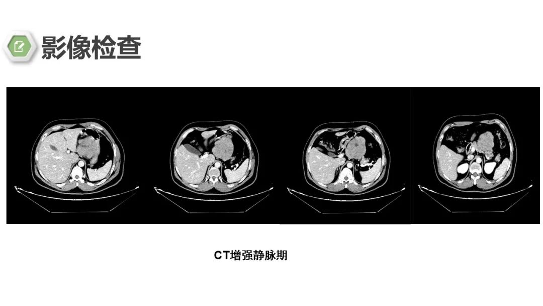 影像PPT - 【病例】胃底间质瘤1例CT影像-6
