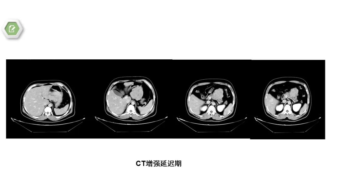 影像PPT - 【病例】胃底间质瘤1例CT影像-7
