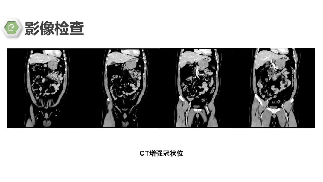 影像PPT - 【病例】胃底间质瘤1例CT影像-8