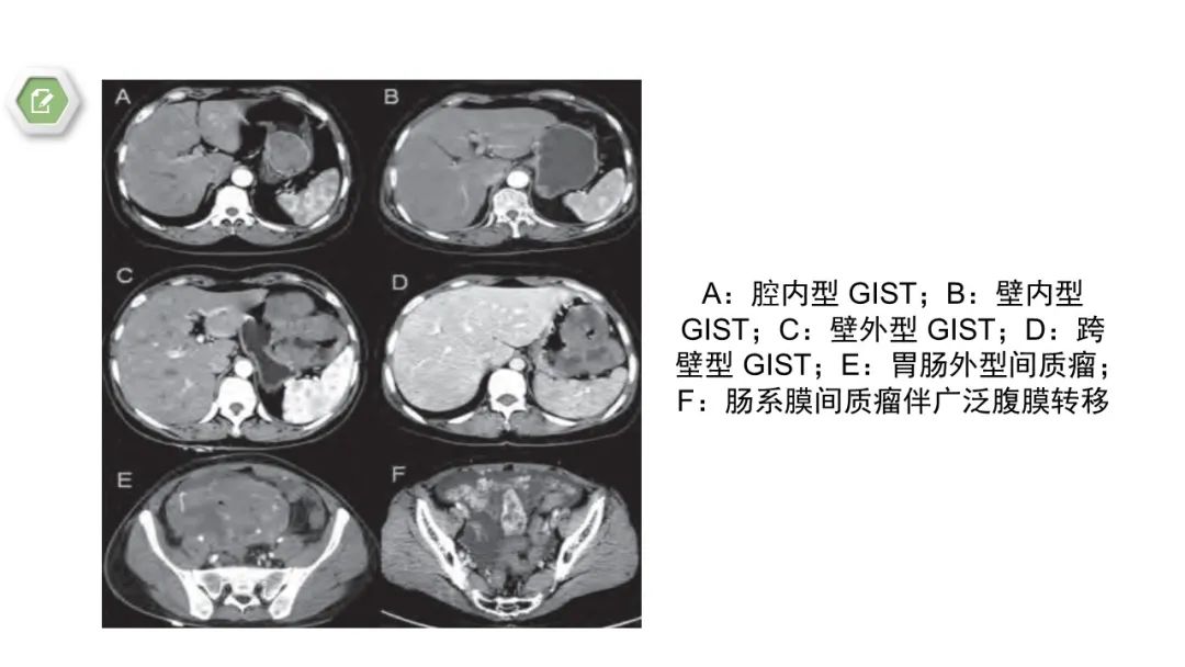 影像PPT - 【病例】胃底间质瘤1例CT影像-16
