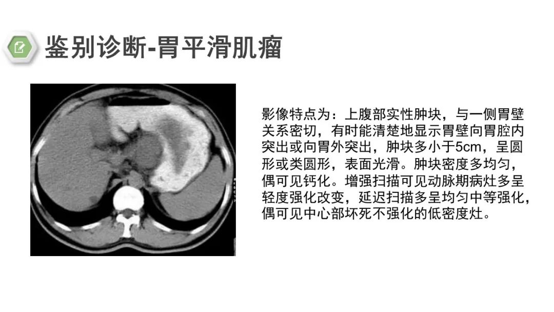 影像PPT - 【病例】胃底间质瘤1例CT影像-19