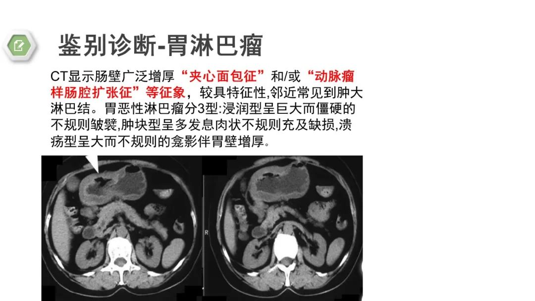 影像PPT - 【病例】胃底间质瘤1例CT影像-20