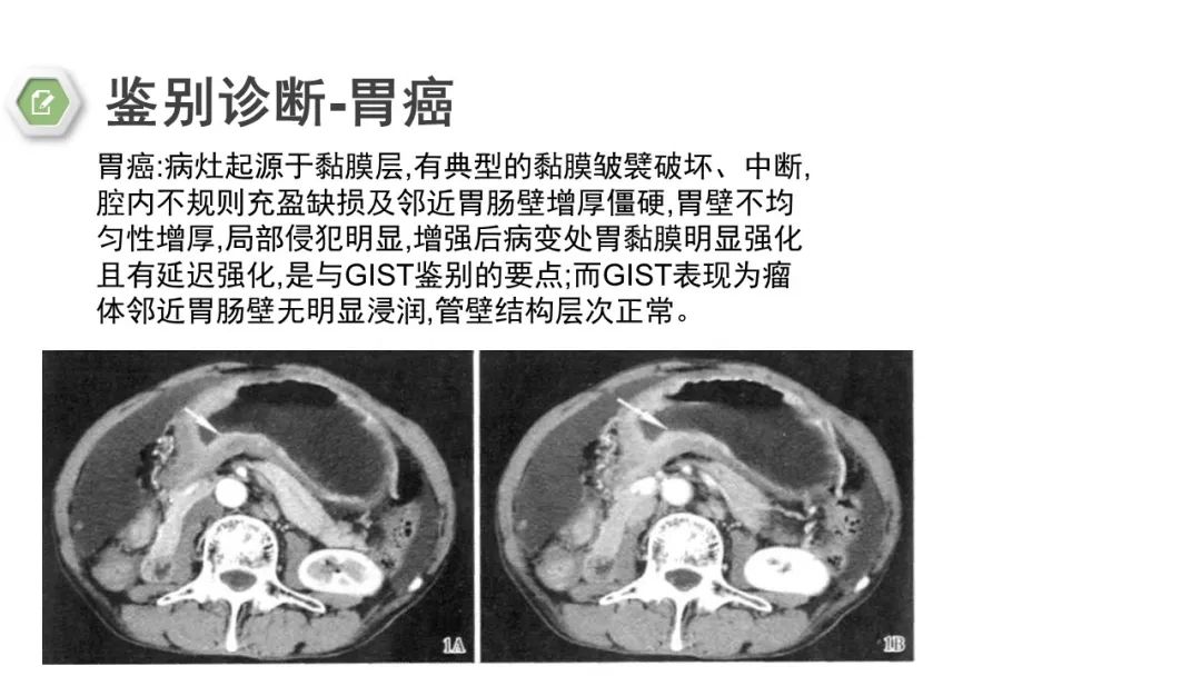 影像PPT - 【病例】胃底间质瘤1例CT影像-21
