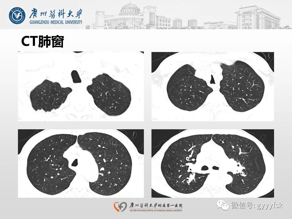 影像PPT - 【病例】支气管淀粉样变1例CT影像-4