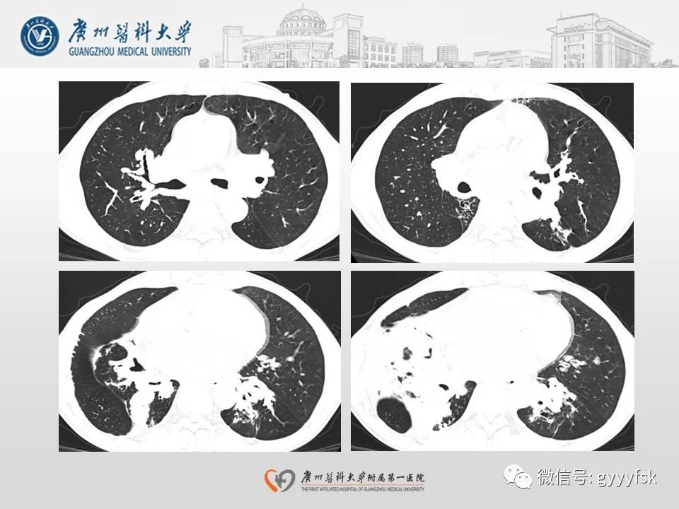影像PPT - 【病例】支气管淀粉样变1例CT影像-5
