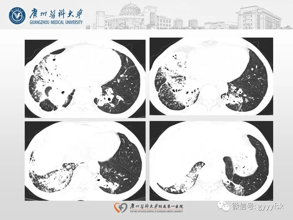 影像PPT - 【病例】支气管淀粉样变1例CT影像-6