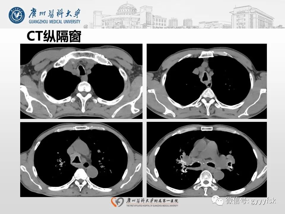 影像PPT - 【病例】支气管淀粉样变1例CT影像-7
