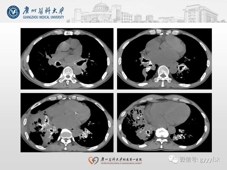 影像PPT - 【病例】支气管淀粉样变1例CT影像-8