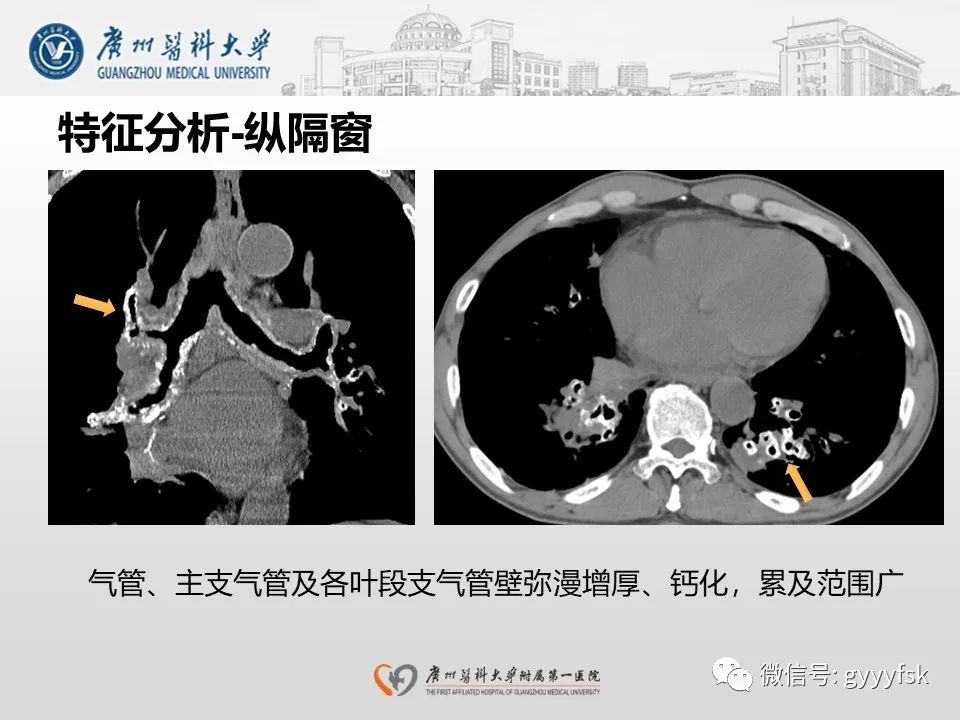 影像PPT - 【病例】支气管淀粉样变1例CT影像-10