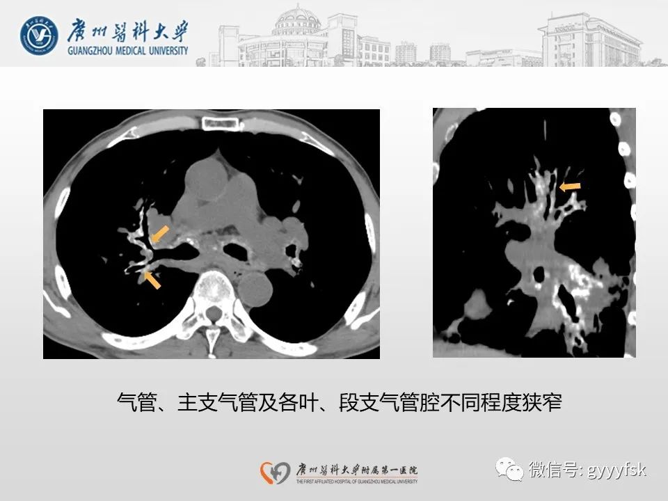 影像PPT - 【病例】支气管淀粉样变1例CT影像-11