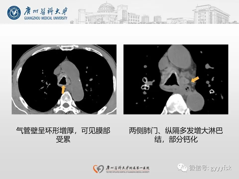 影像PPT - 【病例】支气管淀粉样变1例CT影像-12