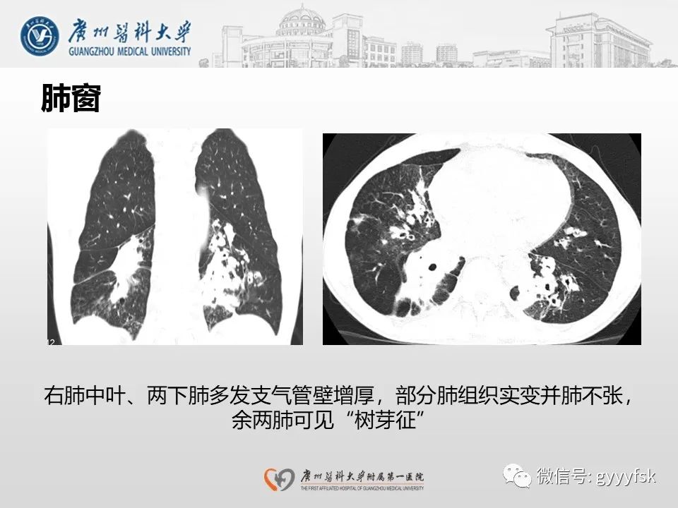 影像PPT - 【病例】支气管淀粉样变1例CT影像-13