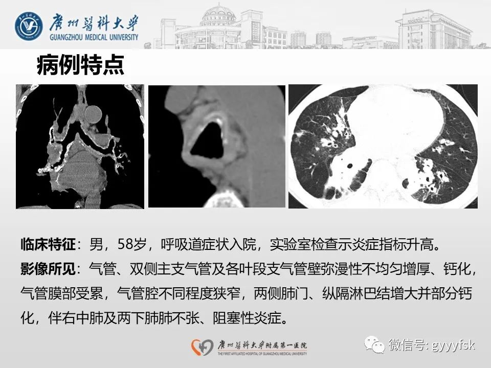 影像PPT - 【病例】支气管淀粉样变1例CT影像-14