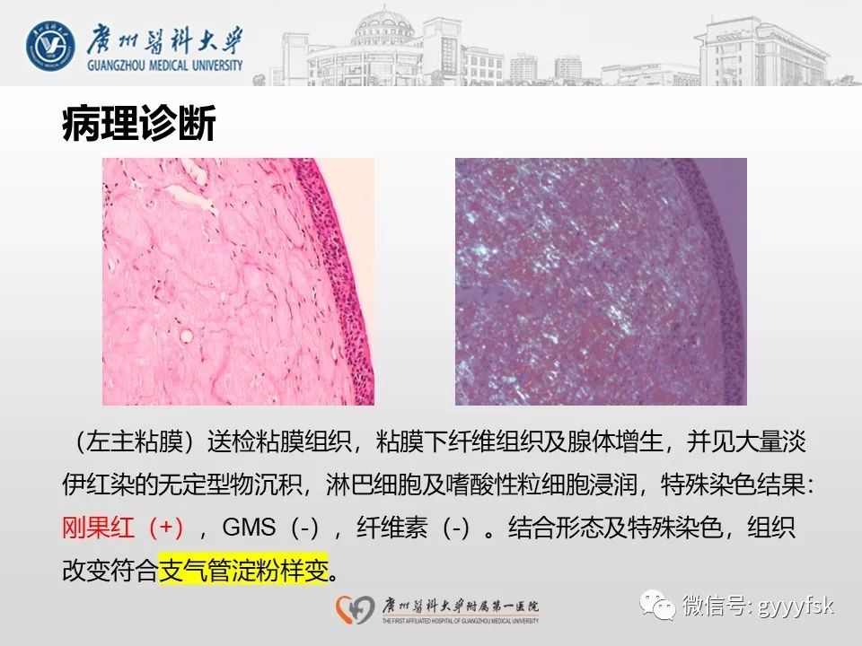 影像PPT - 【病例】支气管淀粉样变1例CT影像-16