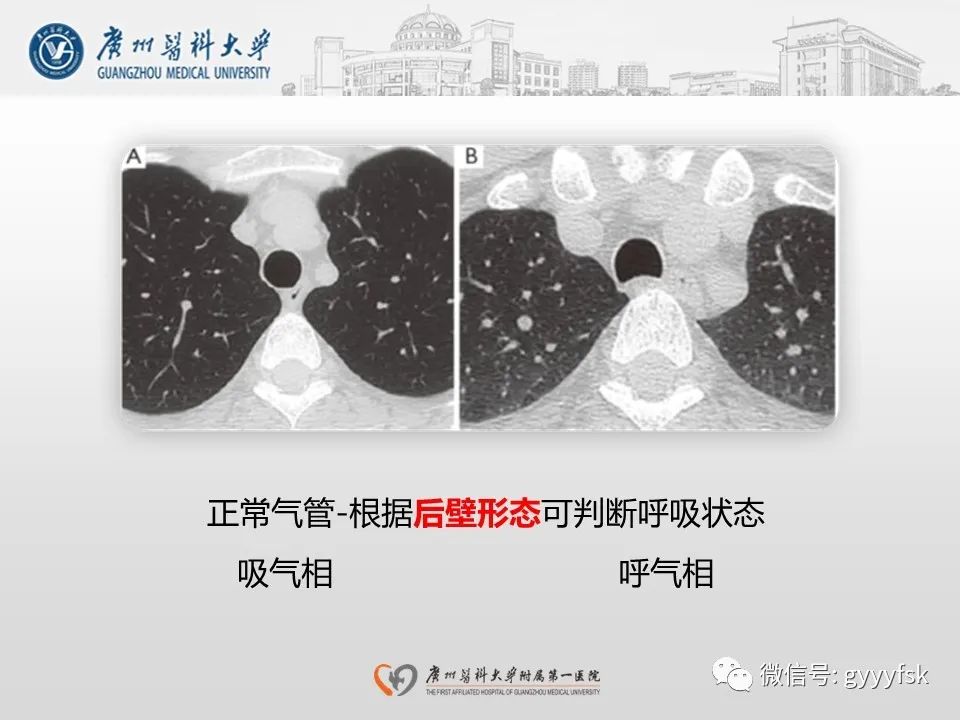 影像PPT - 【病例】支气管淀粉样变1例CT影像-20
