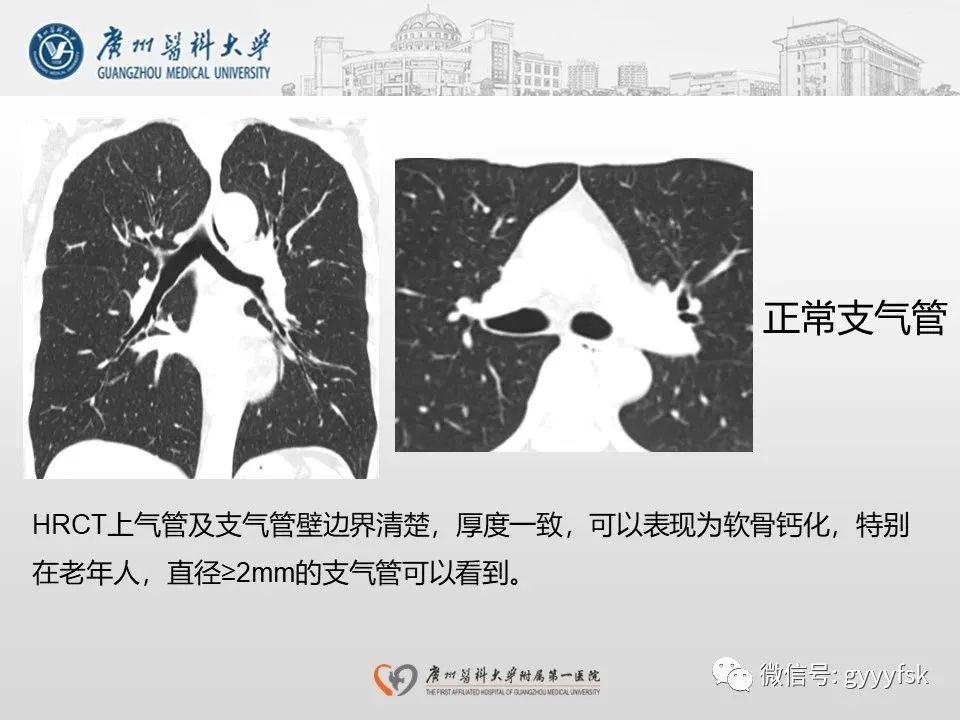 影像PPT - 【病例】支气管淀粉样变1例CT影像-21