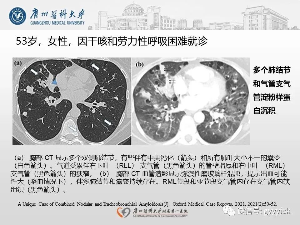 影像PPT - 【病例】支气管淀粉样变1例CT影像-23