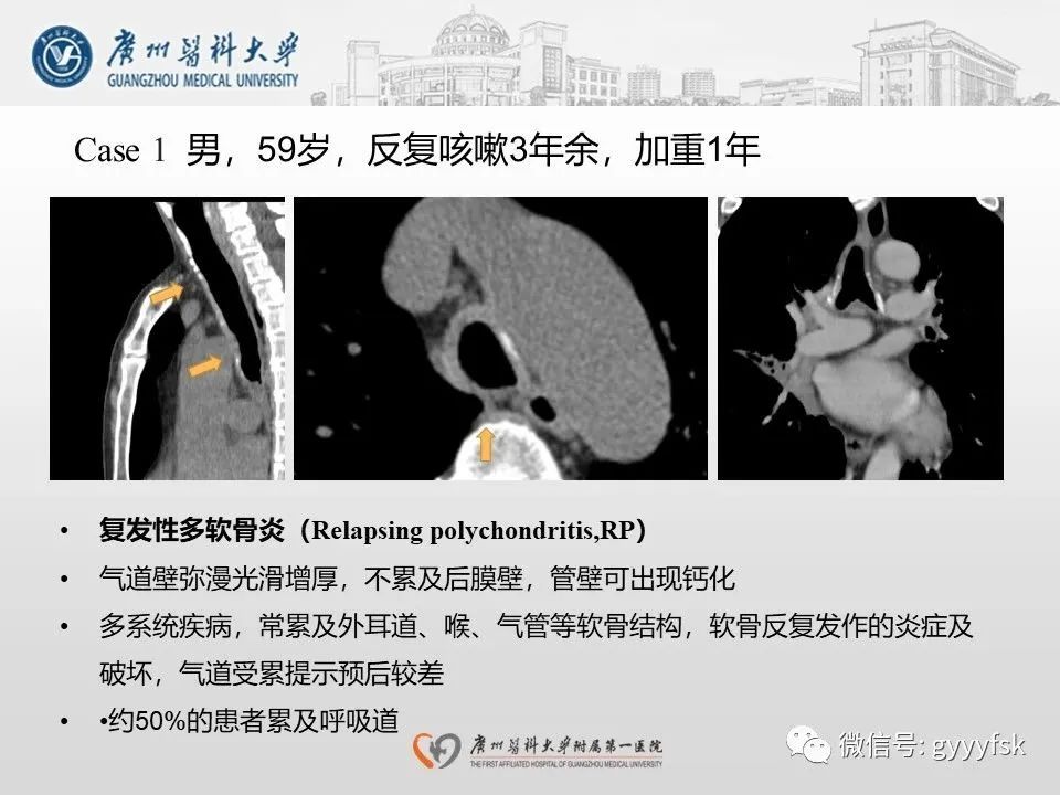 影像PPT - 【病例】支气管淀粉样变1例CT影像-26