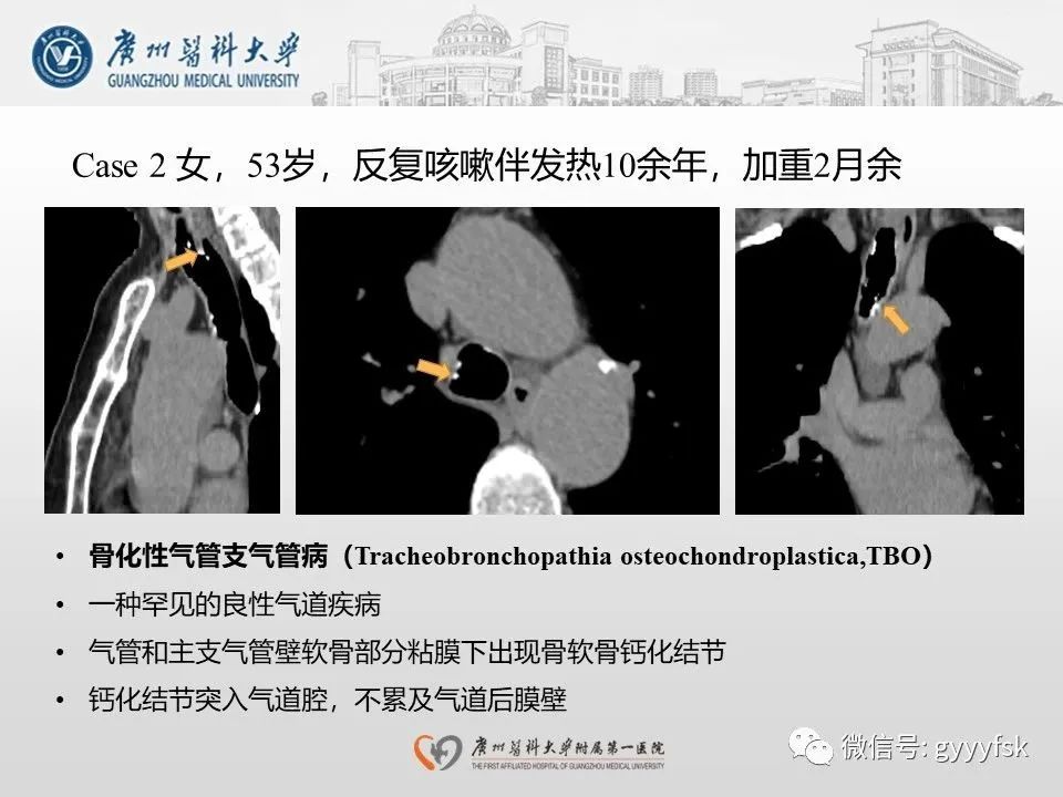 影像PPT - 【病例】支气管淀粉样变1例CT影像-27