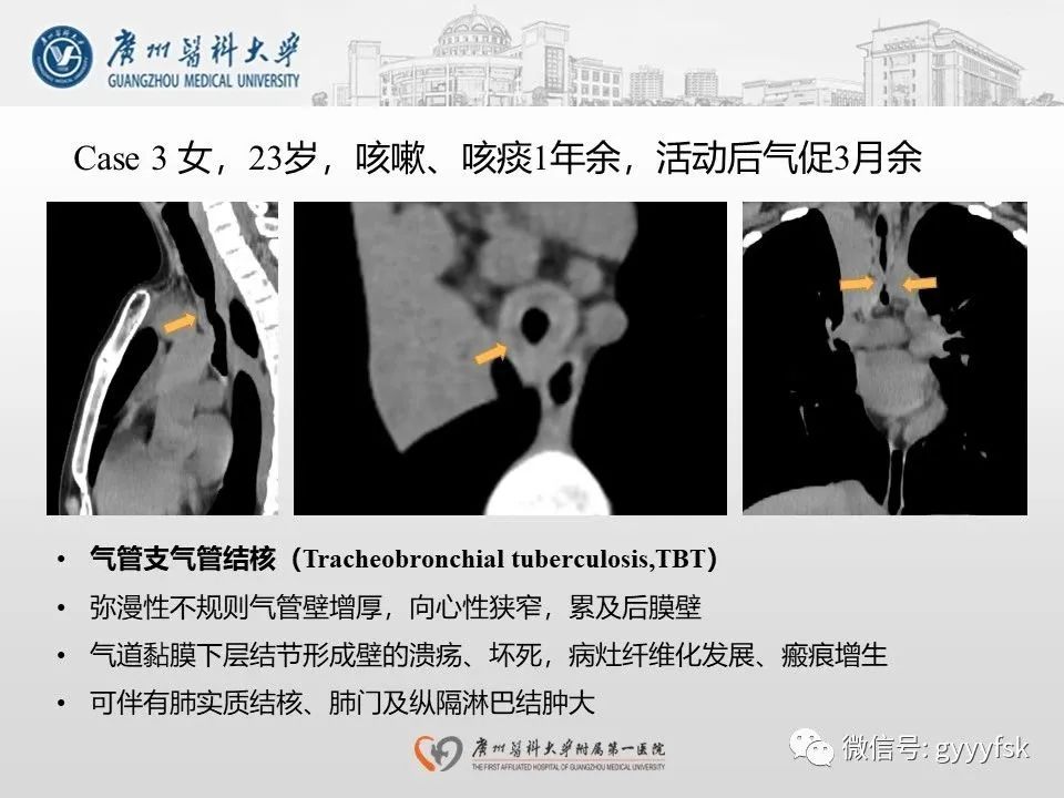 影像PPT - 【病例】支气管淀粉样变1例CT影像-28