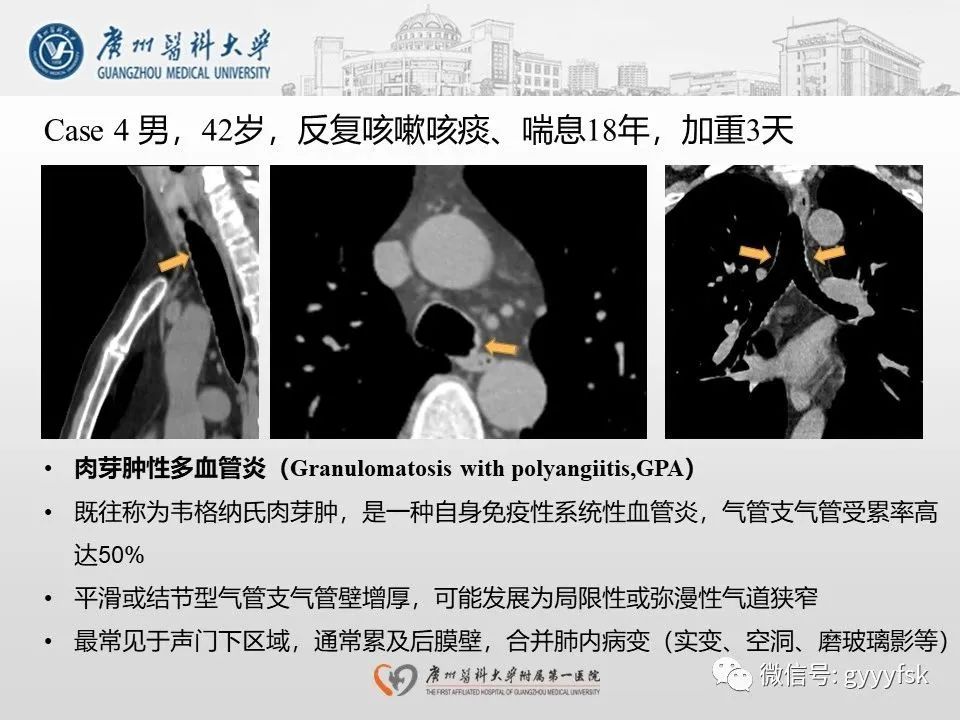 影像PPT - 【病例】支气管淀粉样变1例CT影像-29