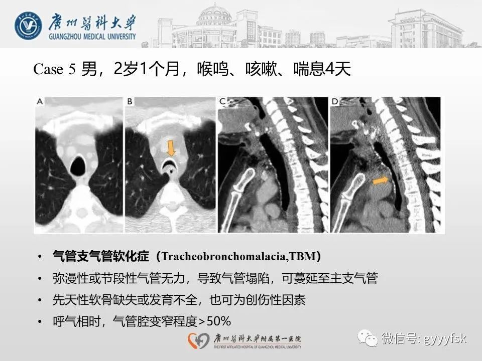 影像PPT - 【病例】支气管淀粉样变1例CT影像-30