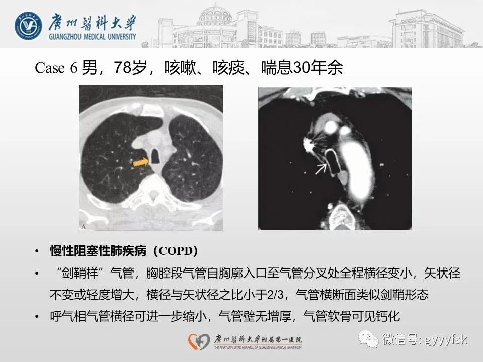 影像PPT - 【病例】支气管淀粉样变1例CT影像-31