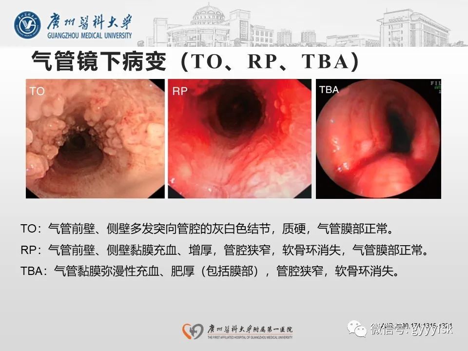 影像PPT - 【病例】支气管淀粉样变1例CT影像-33
