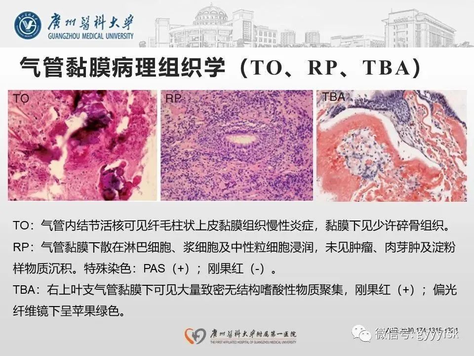 影像PPT - 【病例】支气管淀粉样变1例CT影像-34