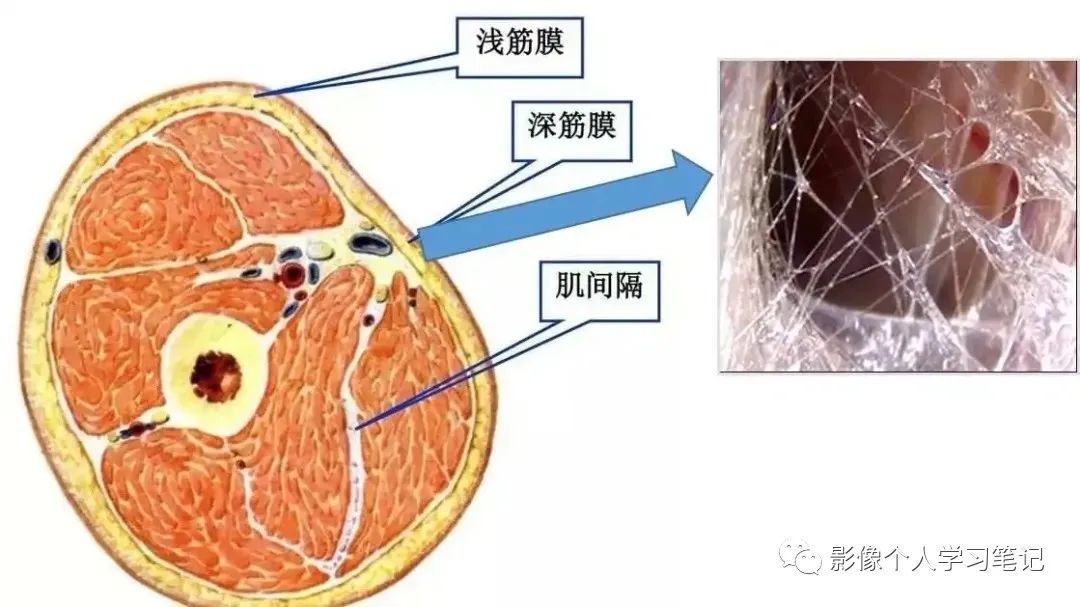 影像PPT - 腰椎MRI容易忽视的腰背部皮下筋膜炎-4 影像PPT - 腰椎MRI容易忽视的腰背部皮下筋膜炎-4