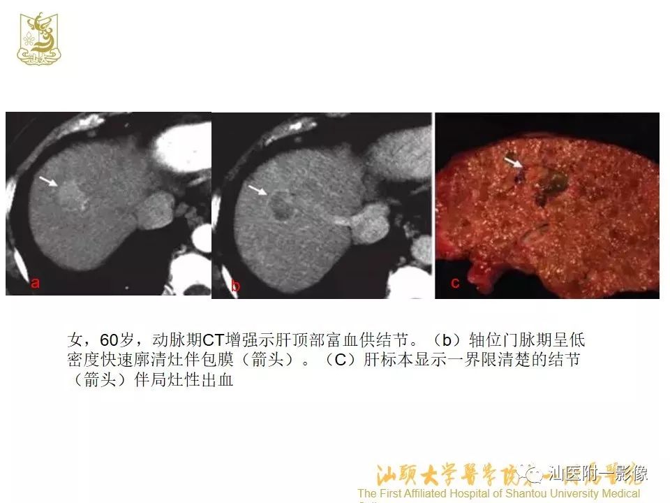 影像PPT - 【PPT】肝脏“快进快出强化” 肿瘤简析-7