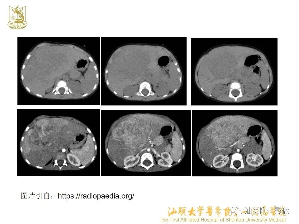 影像PPT - 【PPT】肝脏“快进快出强化” 肿瘤简析-9