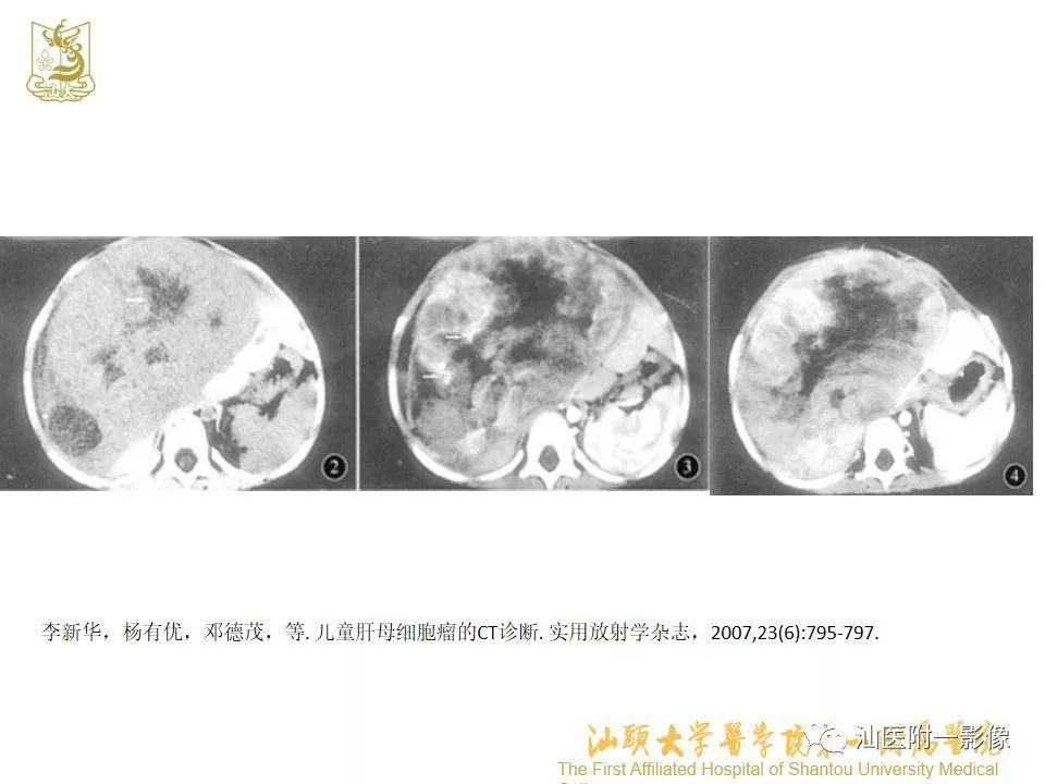 影像PPT - 【PPT】肝脏“快进快出强化” 肿瘤简析-10